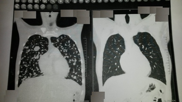 Lungs_Small.jpg