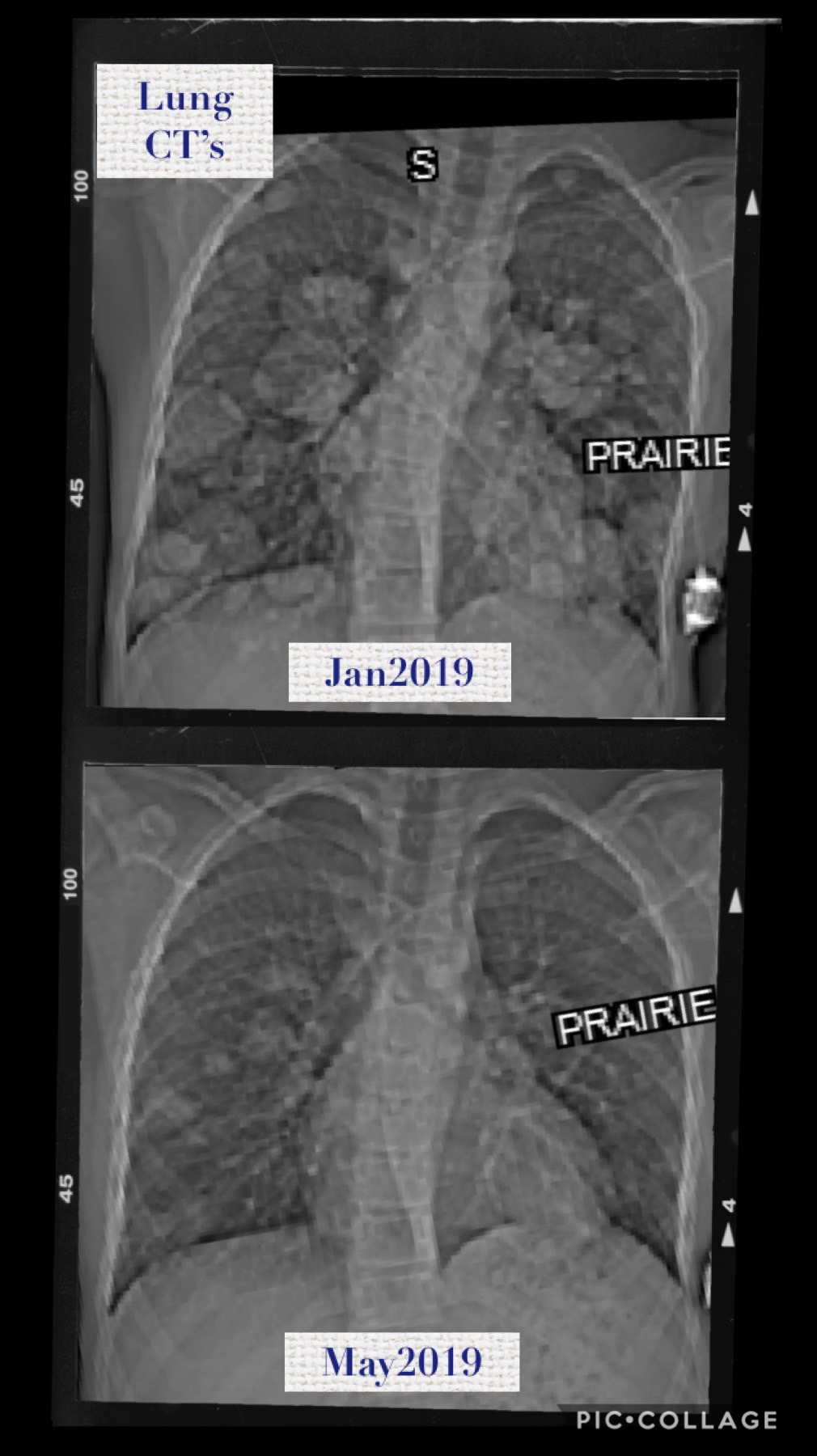 Lung scans