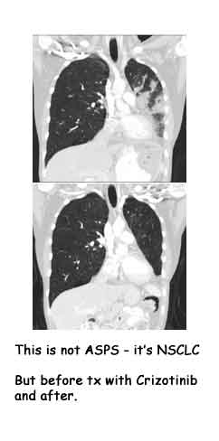 NSCLC-and-Criz.jpg